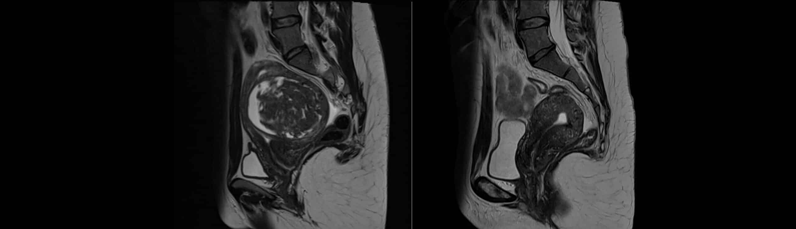 Indication d'embolisation utérine | Embolisation fibrome,embolisation artère utérine| Dr Laouisset | Val-de-Marne