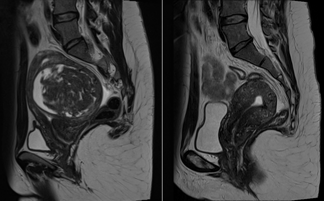 Image rayon X montrant l embolisation uterine | radiologie interventionnelle IMEF