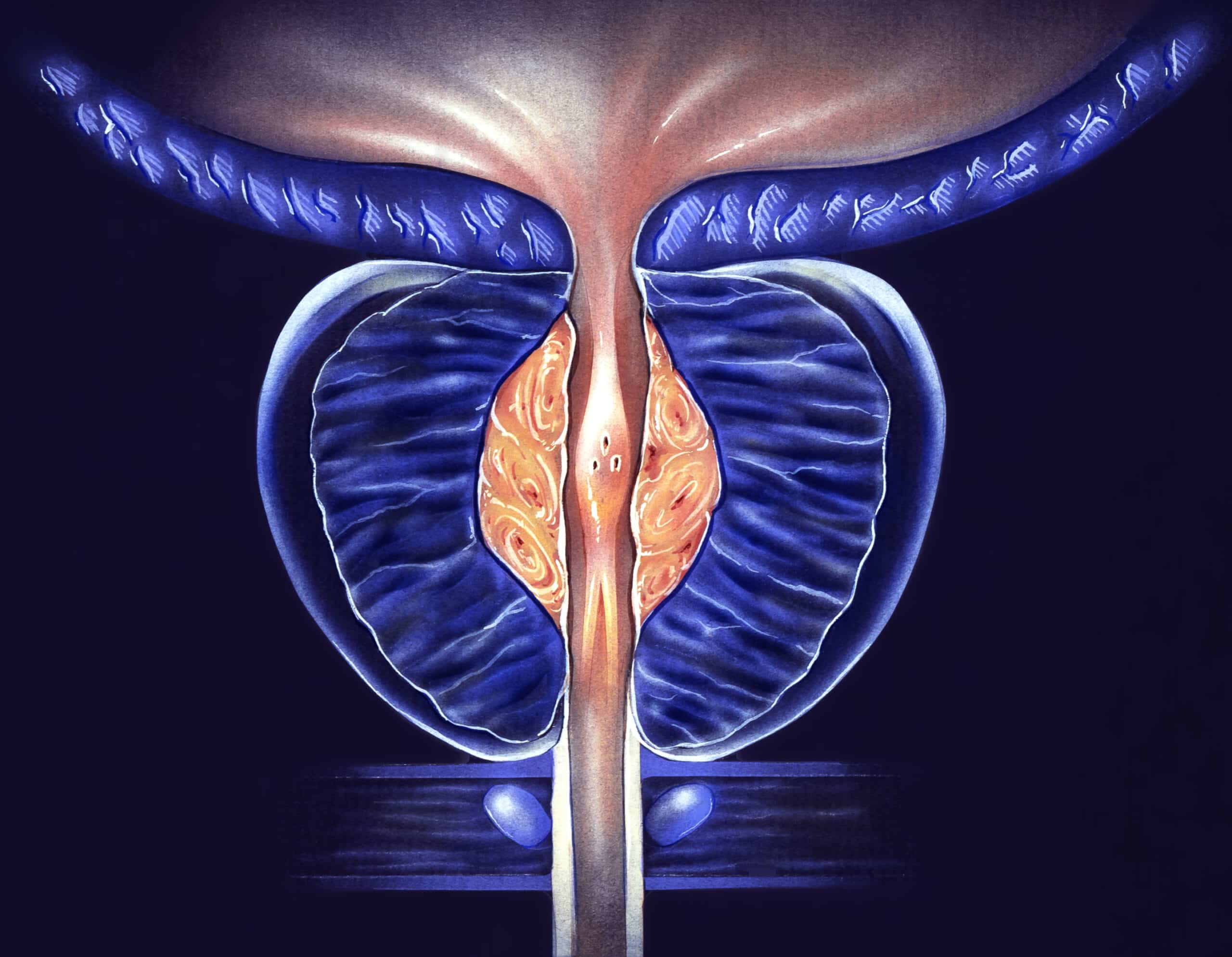 Adénome de prostate | Centre d'imagerie | Adénome prostatique | Dr Laouisset | Val-de-Marne