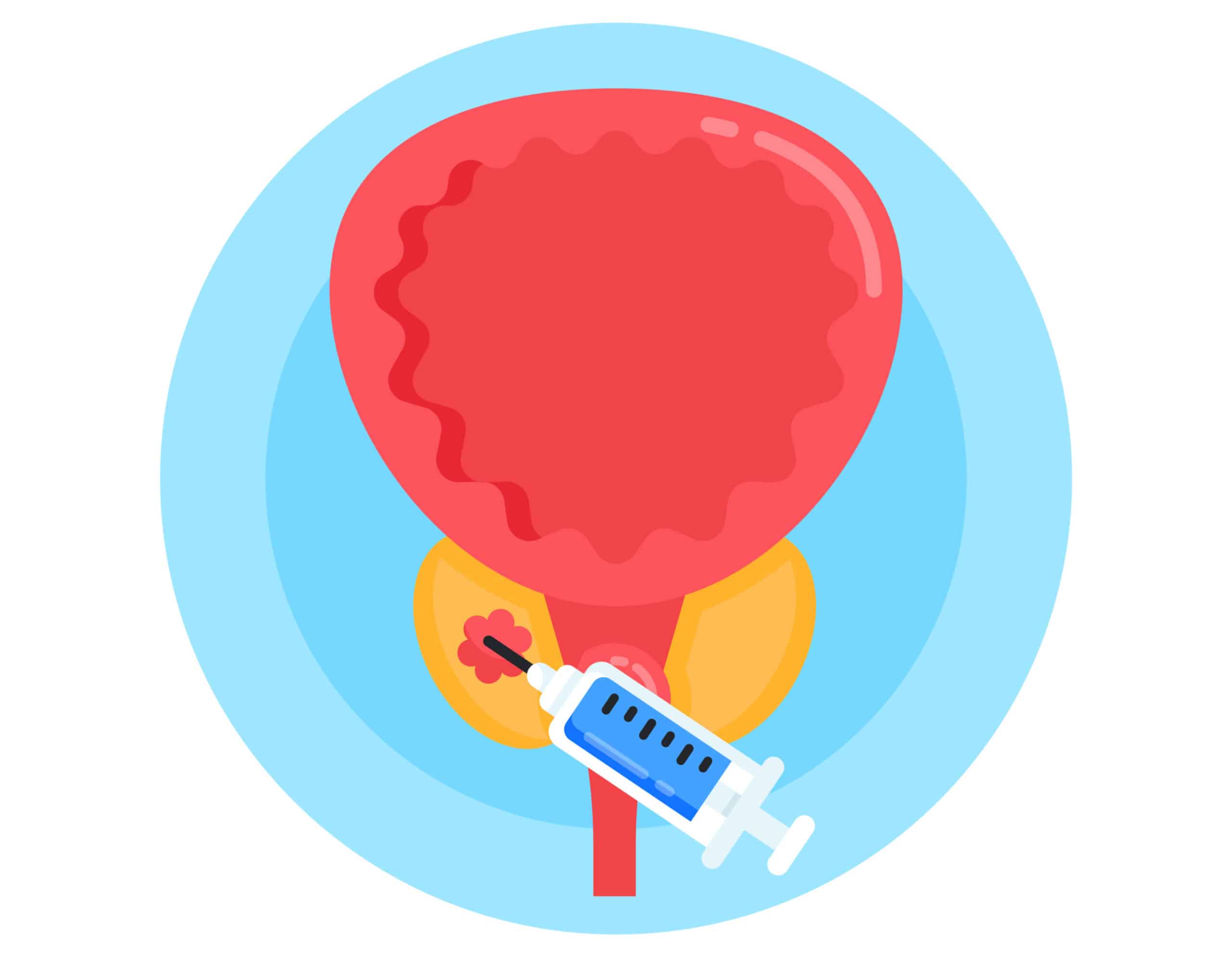 BIopsie prostate dans le Val-de-Marne | Biopsie prostate effets secondaires | Radiologie | Dr Laouisset