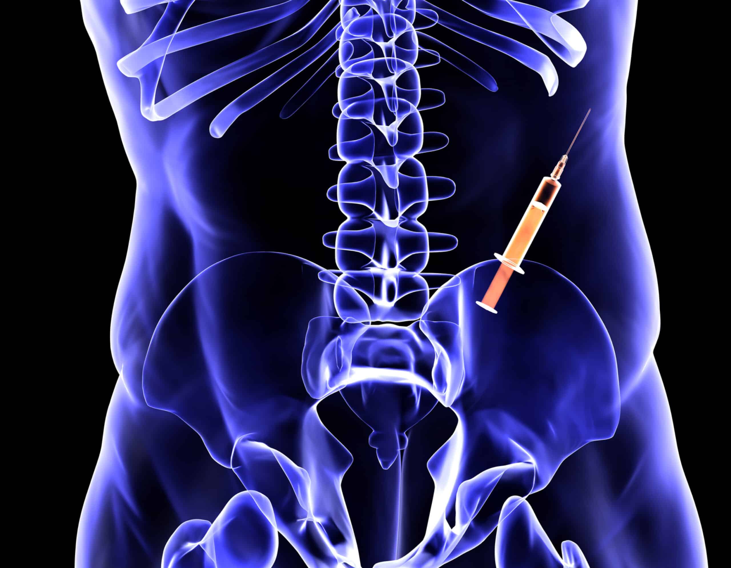 Infiltration rachidienne dans le Val-de-Marne | Centre d'imagerie médicale | Radiologie | Dr Laouisset