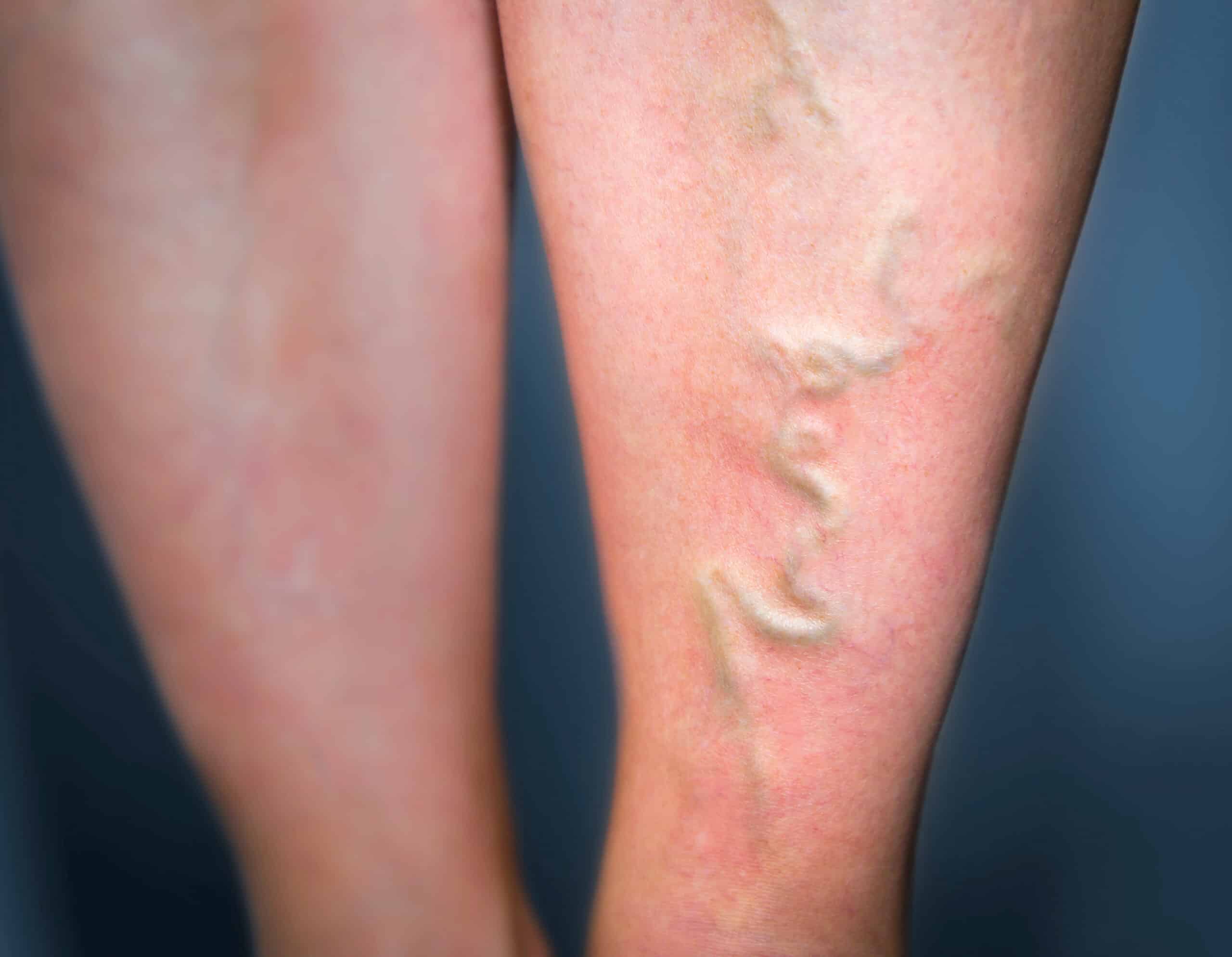 Varices | Centre d'imagerie médicale | Traitement des varices des membres inférieurs | Dr Laouisset | Val-de-Marne