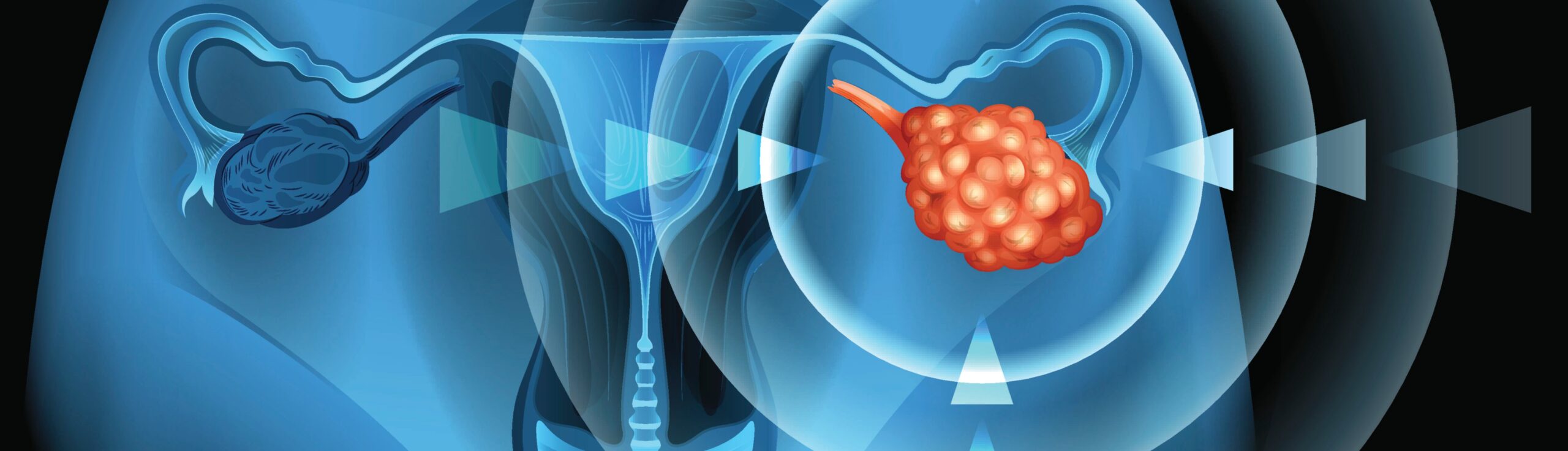 embolisation prostate avec le Dr Laouisset | Val-de-Marne