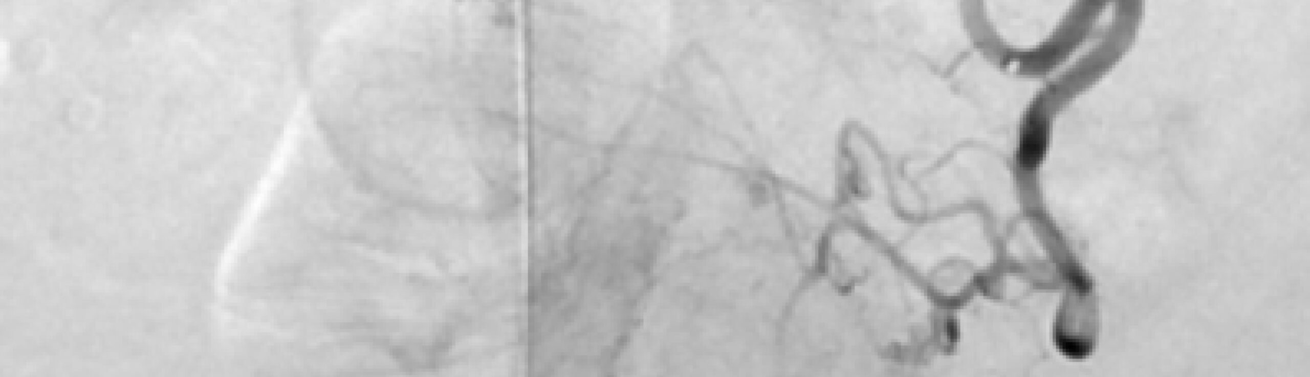 embolisation prostate avec le Dr Laouisset | Val-de-Marne