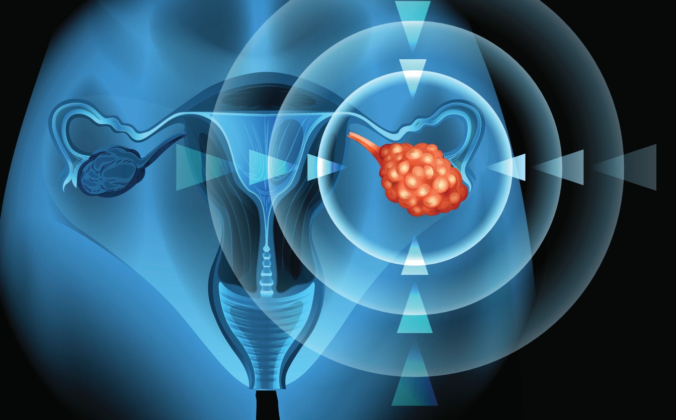 embolisation prostate avec le Dr Laouisset | Val-de-Marne