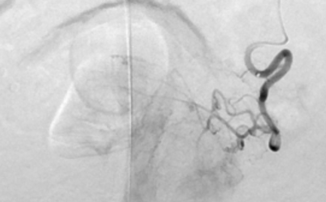 embolisation prostate avec le Dr Laouisset | Val-de-Marne