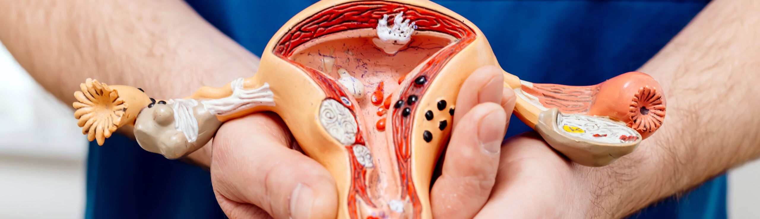 embolisation fibromes uterins avec le Dr Laouisset | Val-de-Marne