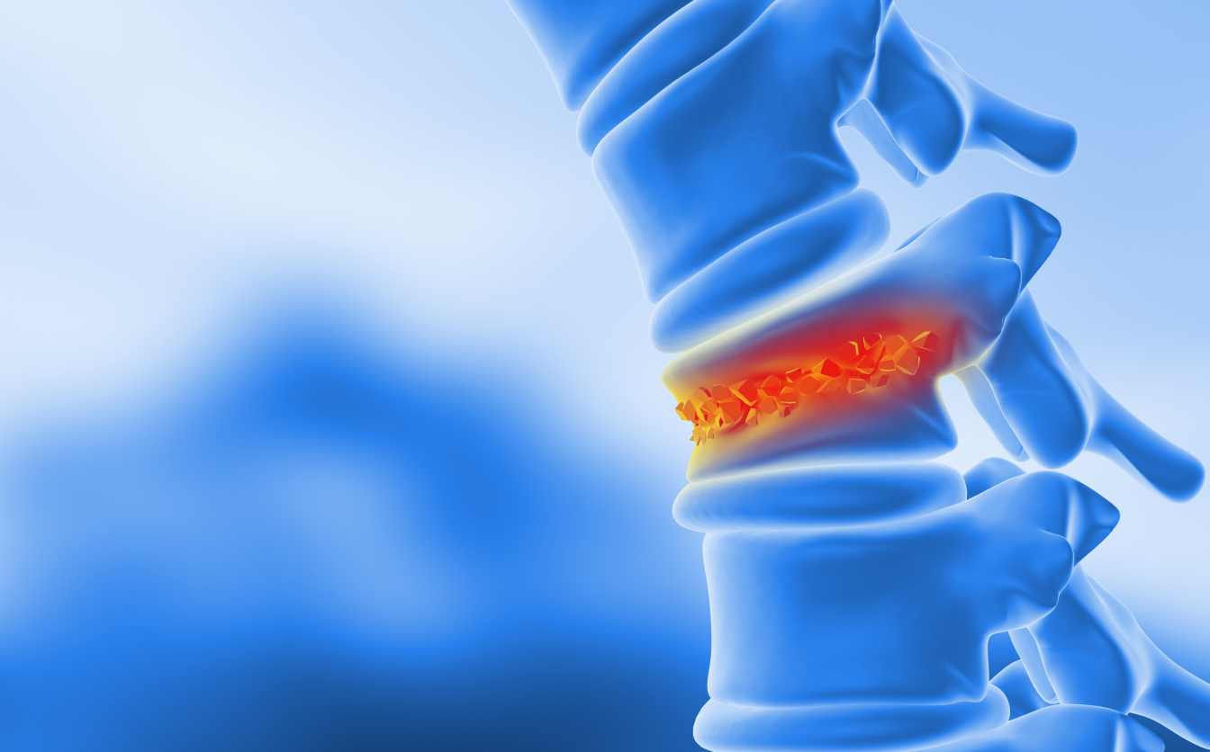 Cimentoplastie avec le Dr Laouisset | Val-de-Marne