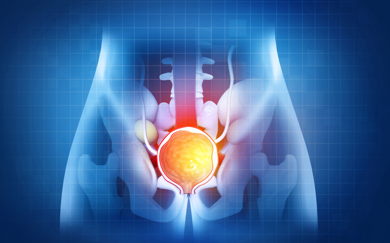 Pourquoi passer une biopsie de la prostate ? | Dr Laouisset | Val-de-Marne